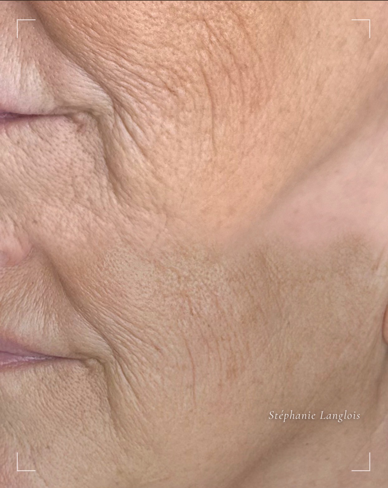 Peau du visage, gros plan résultat anti-âge, Stéphanie Langlois